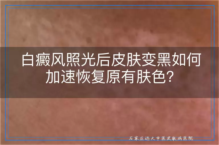 白癜风照光后皮肤变黑如何加速恢复原有肤色？