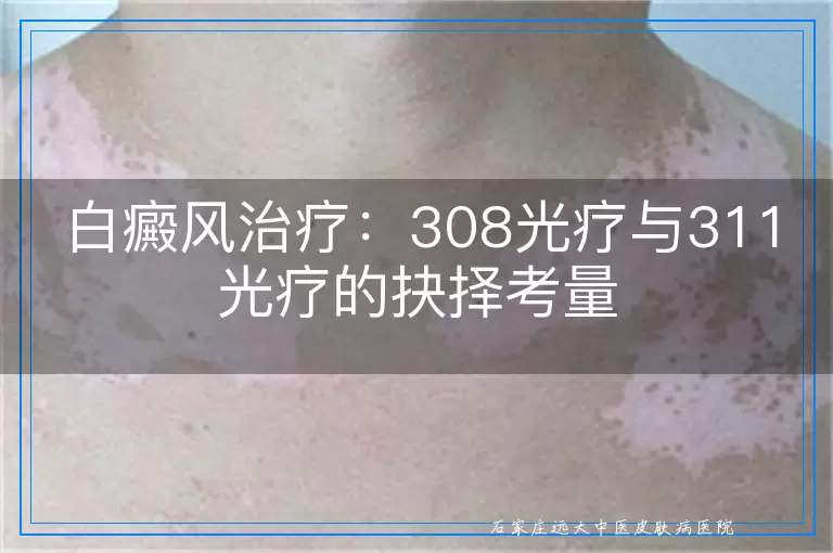 白癜风治疗：308光疗与311光疗的抉择考量