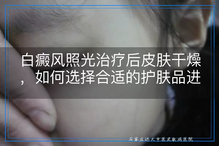 白癜风照光治疗后皮肤干燥，如何选择合适的护肤品进行滋润？