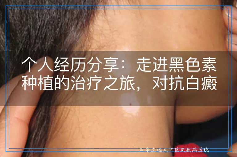 个人经历分享：走进黑色素种植的治疗之旅，对抗白癜风的新篇章