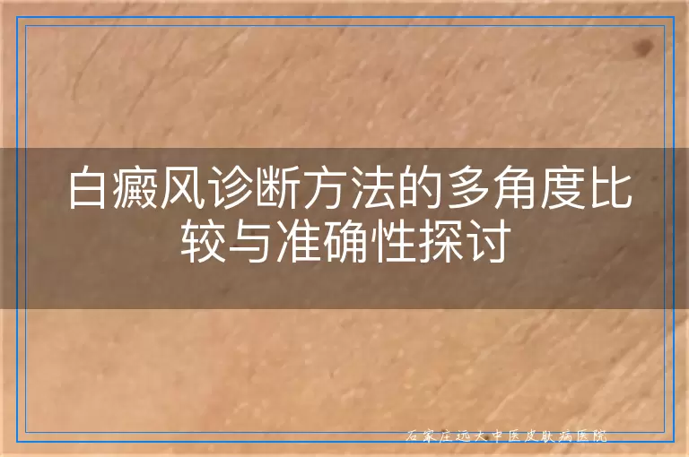 白癜风诊断方法的多角度比较与准确性探讨