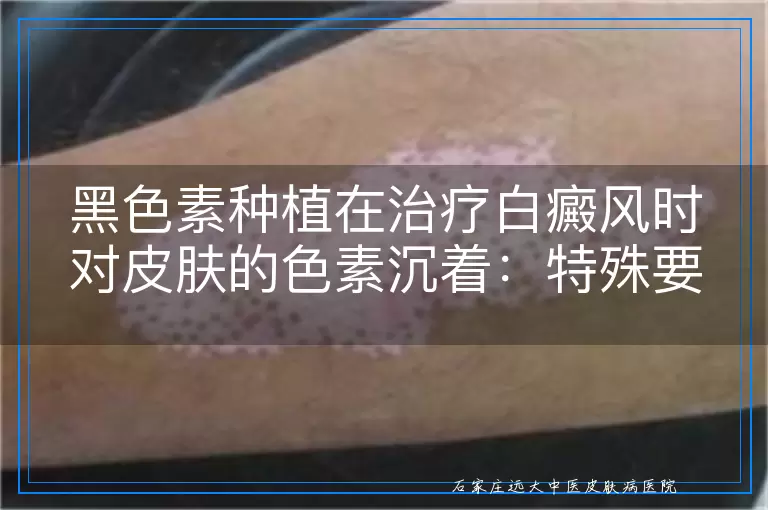 黑色素种植在治疗白癜风时对皮肤的色素沉着：特殊要求与多角度考量