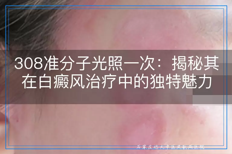 308准分子光照一次：揭秘其在白癜风治疗中的独特魅力与科学实践