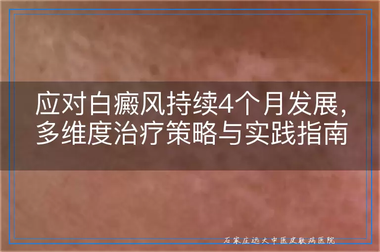 应对白癜风持续4个月发展，多维度治疗策略与实践指南