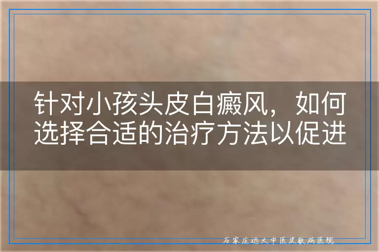 针对小孩头皮白癜风，如何选择合适的治疗方法以促进康复
