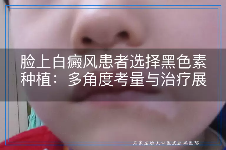 脸上白癜风患者选择黑色素种植：多角度考量与治疗展望