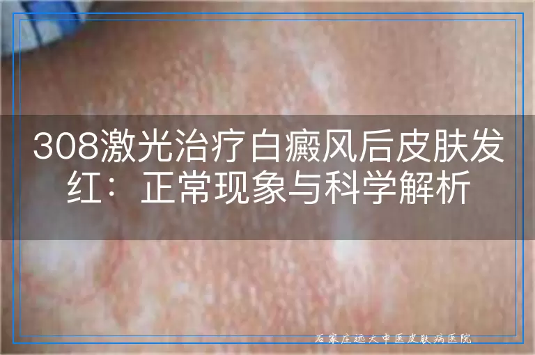308激光治疗白癜风后皮肤发红：正常现象与科学解析