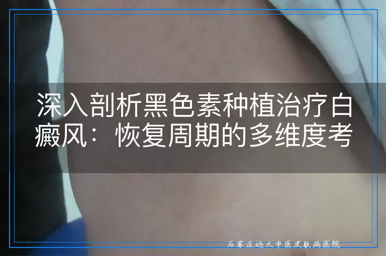 深入剖析黑色素种植治疗白癜风：恢复周期的多维度考量