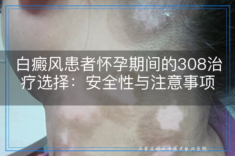 白癜风患者怀孕期间的308治疗选择：安全性与注意事项