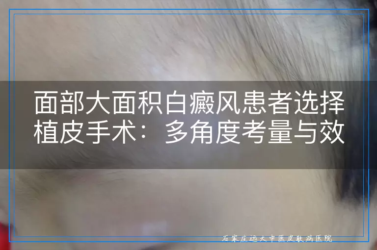 面部大面积白癜风患者选择植皮手术：多角度考量与效果预期