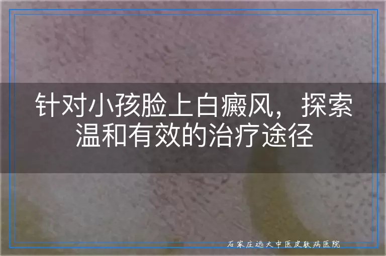针对小孩脸上白癜风，探索温和有效的治疗途径