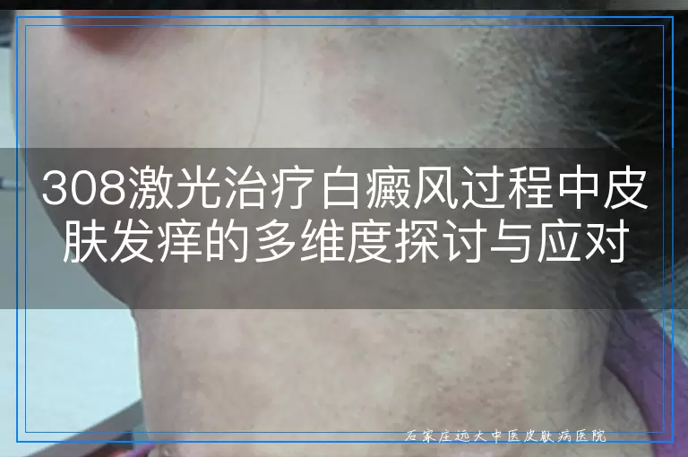 308激光治疗白癜风过程中皮肤发痒的多维度探讨与应对