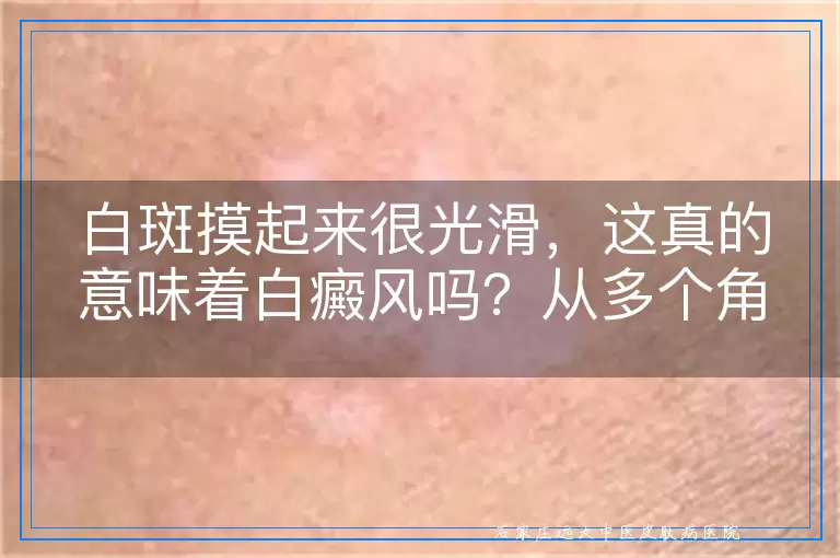 白斑摸起来很光滑，这真的意味着白癜风吗？从多个角度解读这一疑问