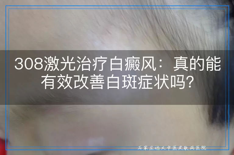 308激光治疗白癜风：真的能有效改善白斑症状吗？