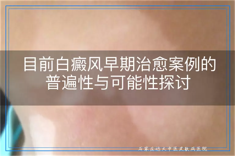 目前白癜风早期治愈案例的普遍性与可能性探讨
