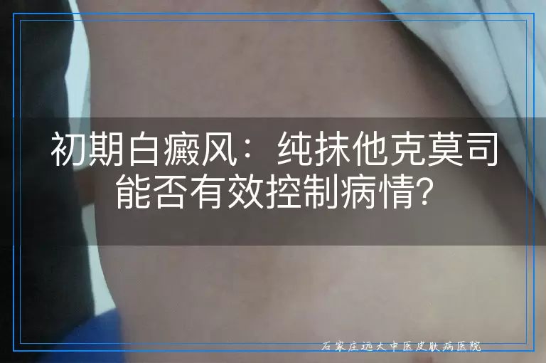 初期白癜风：纯抹他克莫司能否有效控制病情？