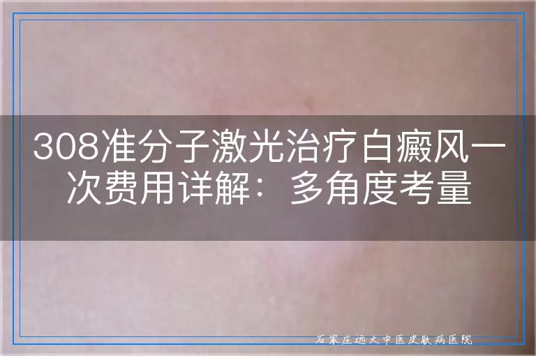 308准分子激光治疗白癜风一次费用详解：多角度考量
