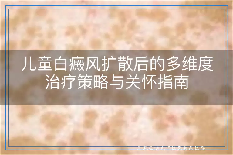 儿童白癜风扩散后的多维度治疗策略与关怀指南