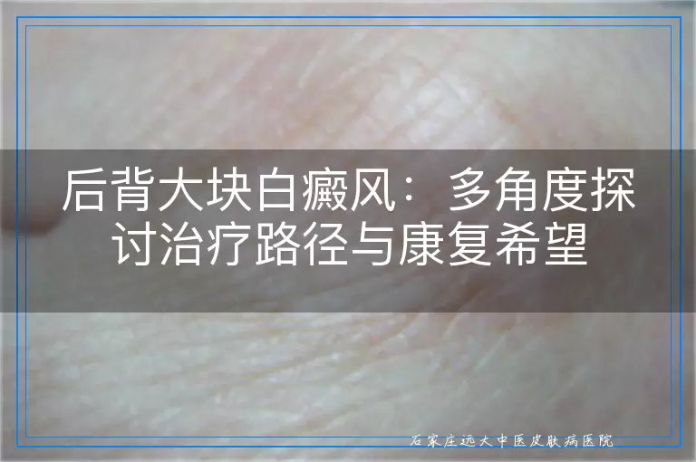后背大块白癜风：多角度探讨治疗路径与康复希望