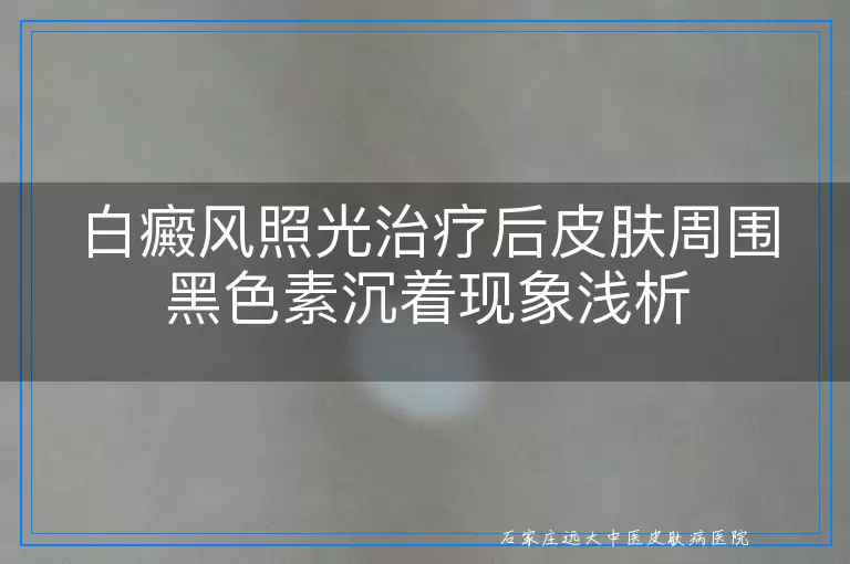 白癜风照光治疗后皮肤周围黑色素沉着现象浅析
