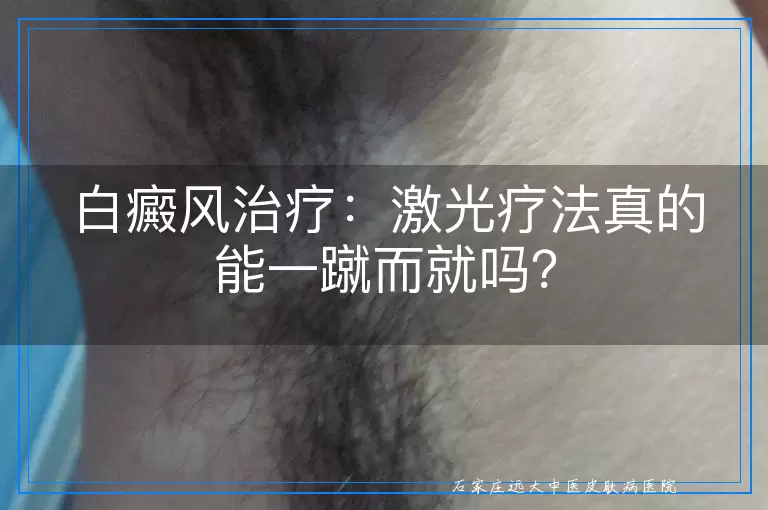 白癜风治疗：激光疗法真的能一蹴而就吗？