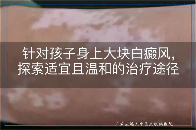 针对孩子身上大块白癜风，探索适宜且温和的治疗途径