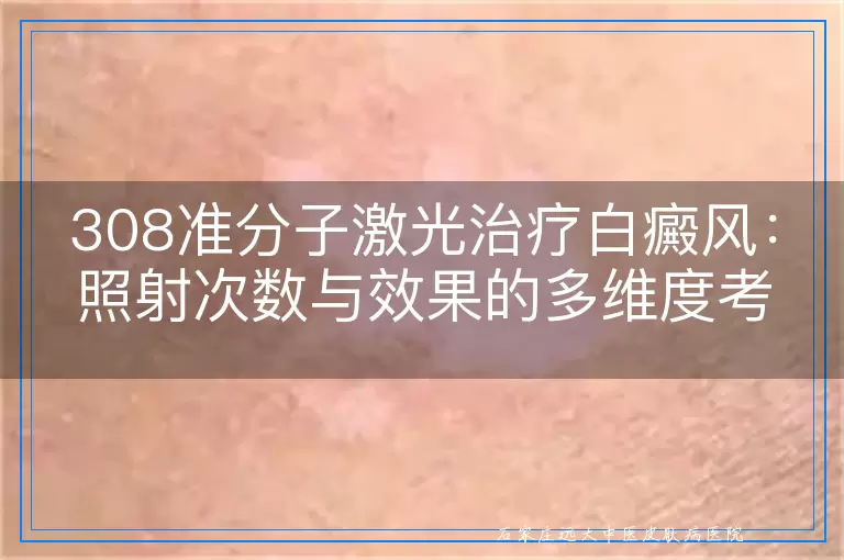 308准分子激光治疗白癜风：照射次数与效果的多维度考量