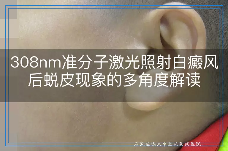 308nm准分子激光照射白癜风后蜕皮现象的多角度解读