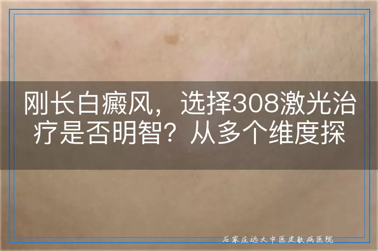 刚长白癜风，选择308激光治疗是否明智？从多个维度探讨其优劣