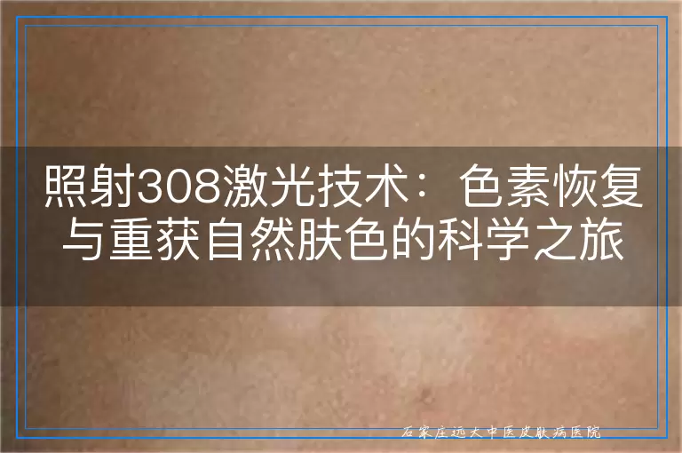 照射308激光技术：色素恢复与重获自然肤色的科学之旅