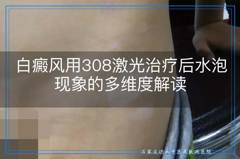白癜风用308激光治疗后水泡现象的多维度解读