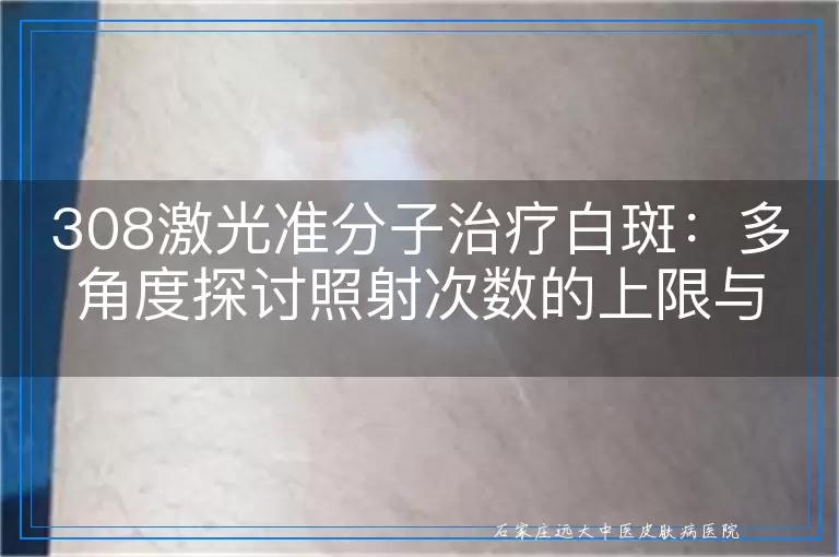 308激光准分子治疗白斑：多角度探讨照射次数的上限与考量因素