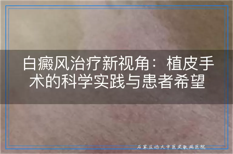 白癜风治疗新视角：植皮手术的科学实践与患者希望