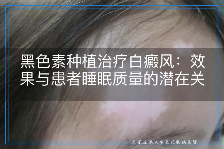 黑色素种植治疗白癜风：效果与患者睡眠质量的潜在关联探讨