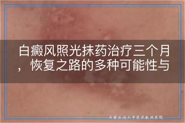 白癜风照光抹药治疗三个月，恢复之路的多种可能性与期待