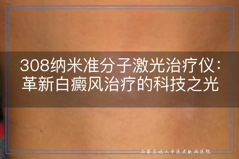 308纳米准分子激光治疗仪：革新白癜风治疗的科技之光