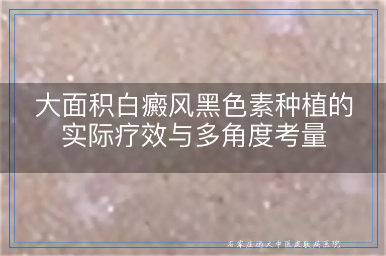 大面积白癜风黑色素种植的实际疗效与多角度考量