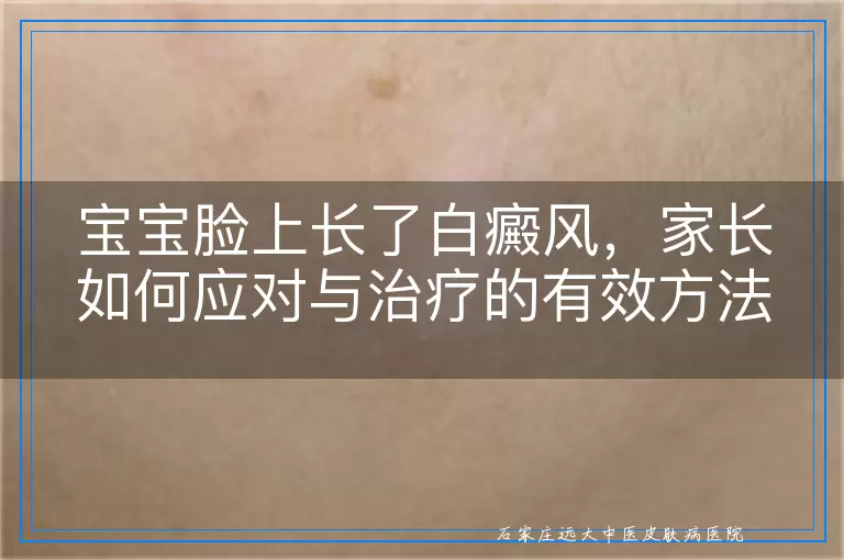 宝宝脸上长了白癜风，家长如何应对与治疗的有效方法
