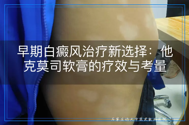 早期白癜风治疗新选择：他克莫司软膏的疗效与考量