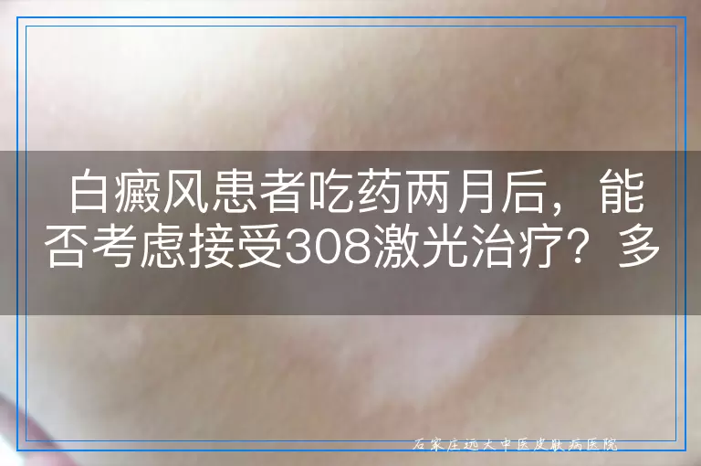 白癜风患者吃药两月后，能否考虑接受308激光治疗？多角度探讨