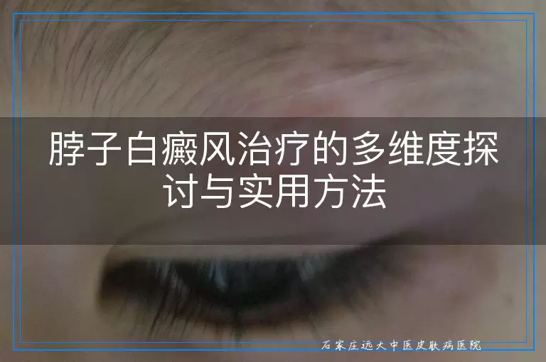 脖子白癜风治疗的多维度探讨与实用方法