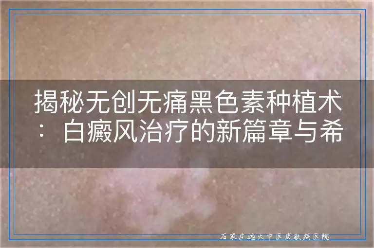 揭秘无创无痛黑色素种植术：白癜风治疗的新篇章与希望之光