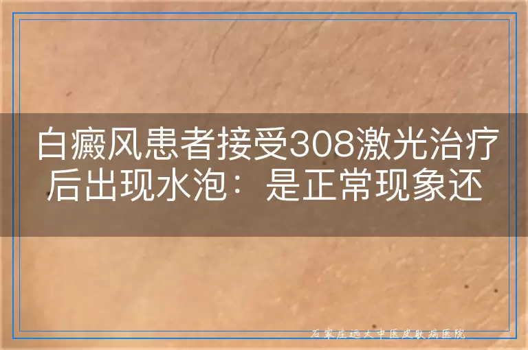 白癜风患者接受308激光治疗后出现水泡：是正常现象还是需关注？