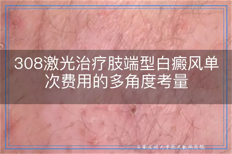 308激光治疗肢端型白癜风单次费用的多角度考量