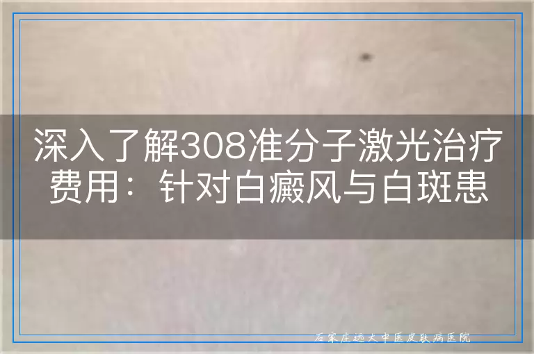 深入了解308准分子激光治疗费用：针对白癜风与白斑患者的经济考量