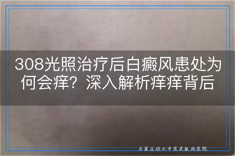 308光照治疗后白癜风患处为何会痒？深入解析痒痒背后的秘密与应对之道