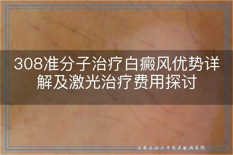 308准分子治疗白癜风优势详解及激光治疗费用探讨