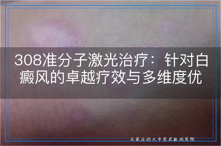 308准分子激光治疗：针对白癜风的卓越疗效与多维度优势解析