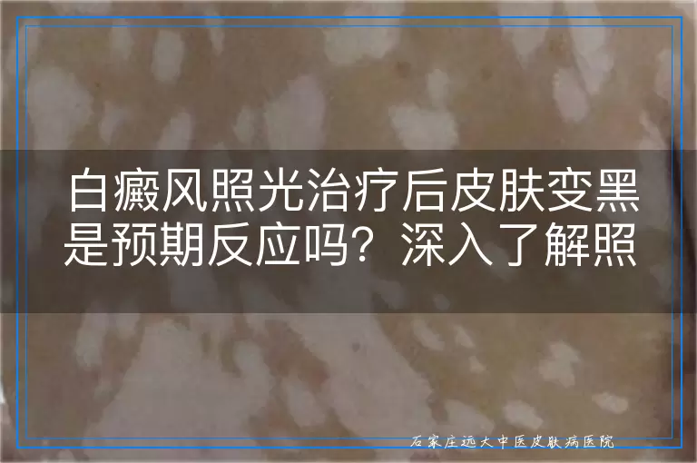 白癜风照光治疗后皮肤变黑是预期反应吗？深入了解照光疗法与皮肤色素变化