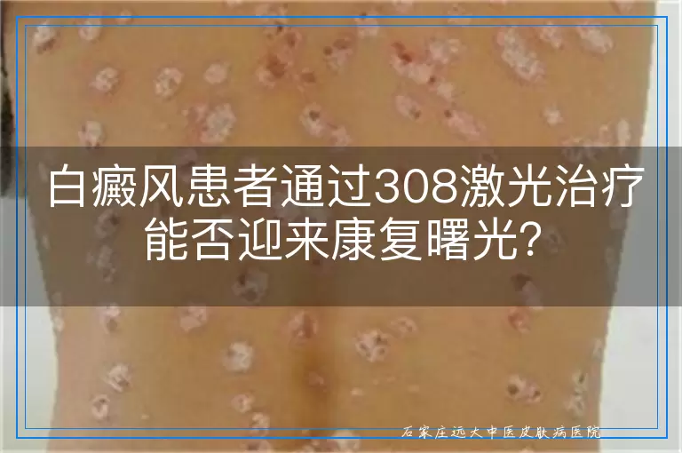 白癜风患者通过308激光治疗能否迎来康复曙光？